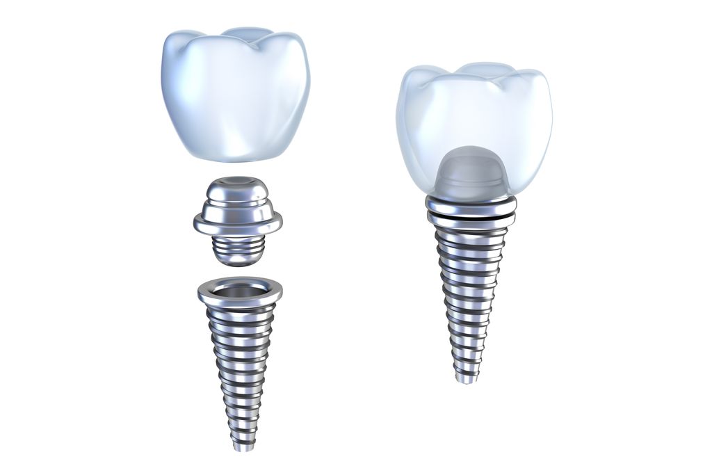 噛む力や見た目に配慮したインプラント治療