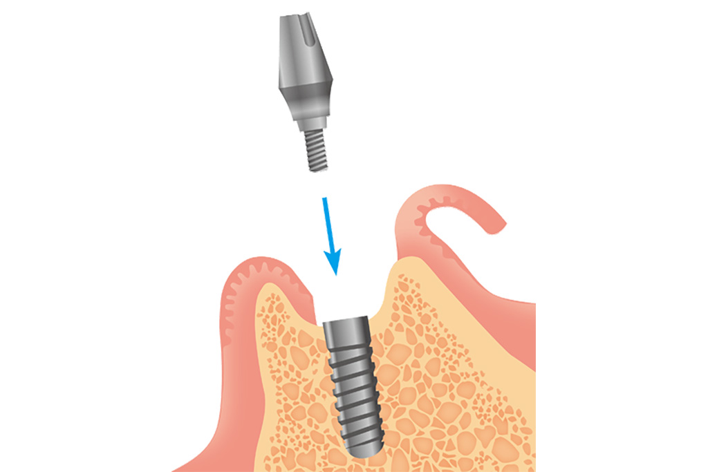 2次手術（アバットメントの装着）