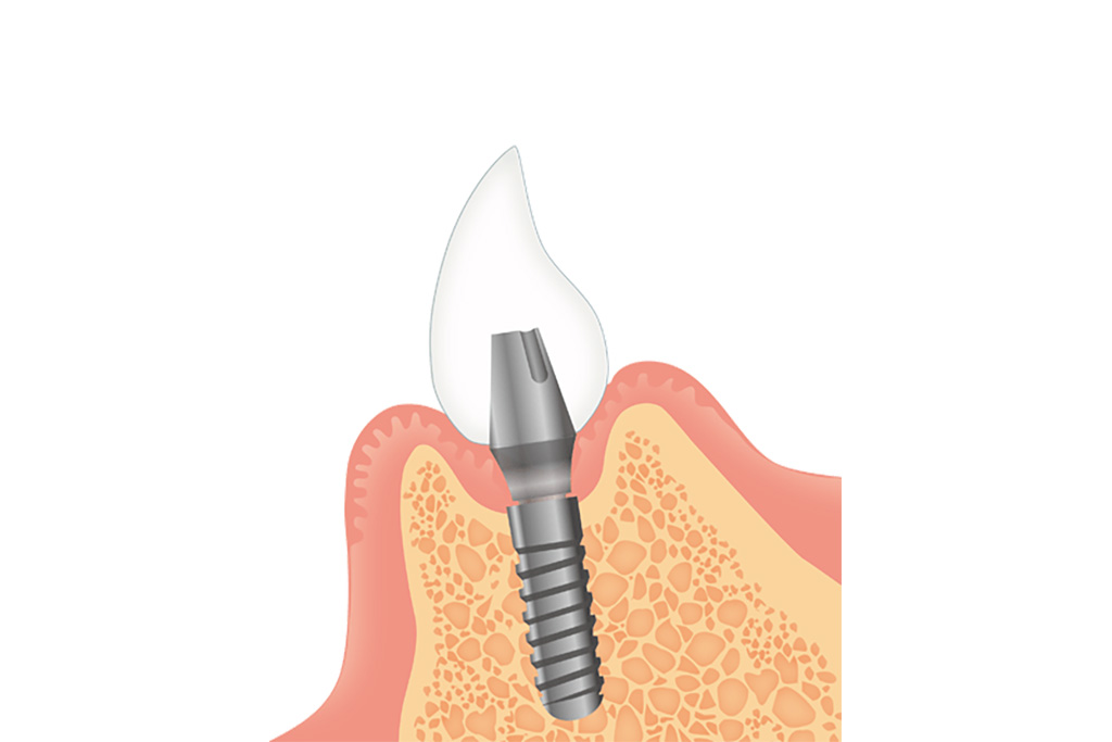 人工歯（上部構造）の装着
