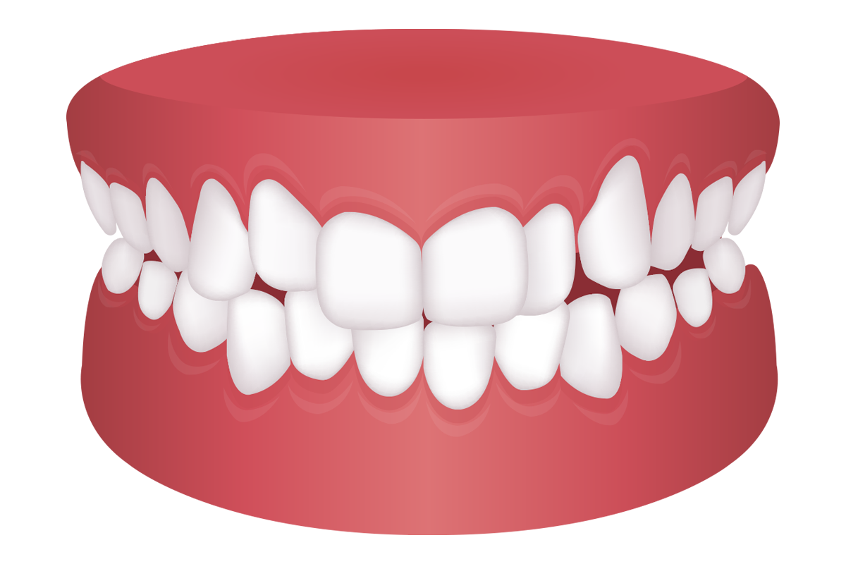 軽度な叢生（乱ぐい歯）