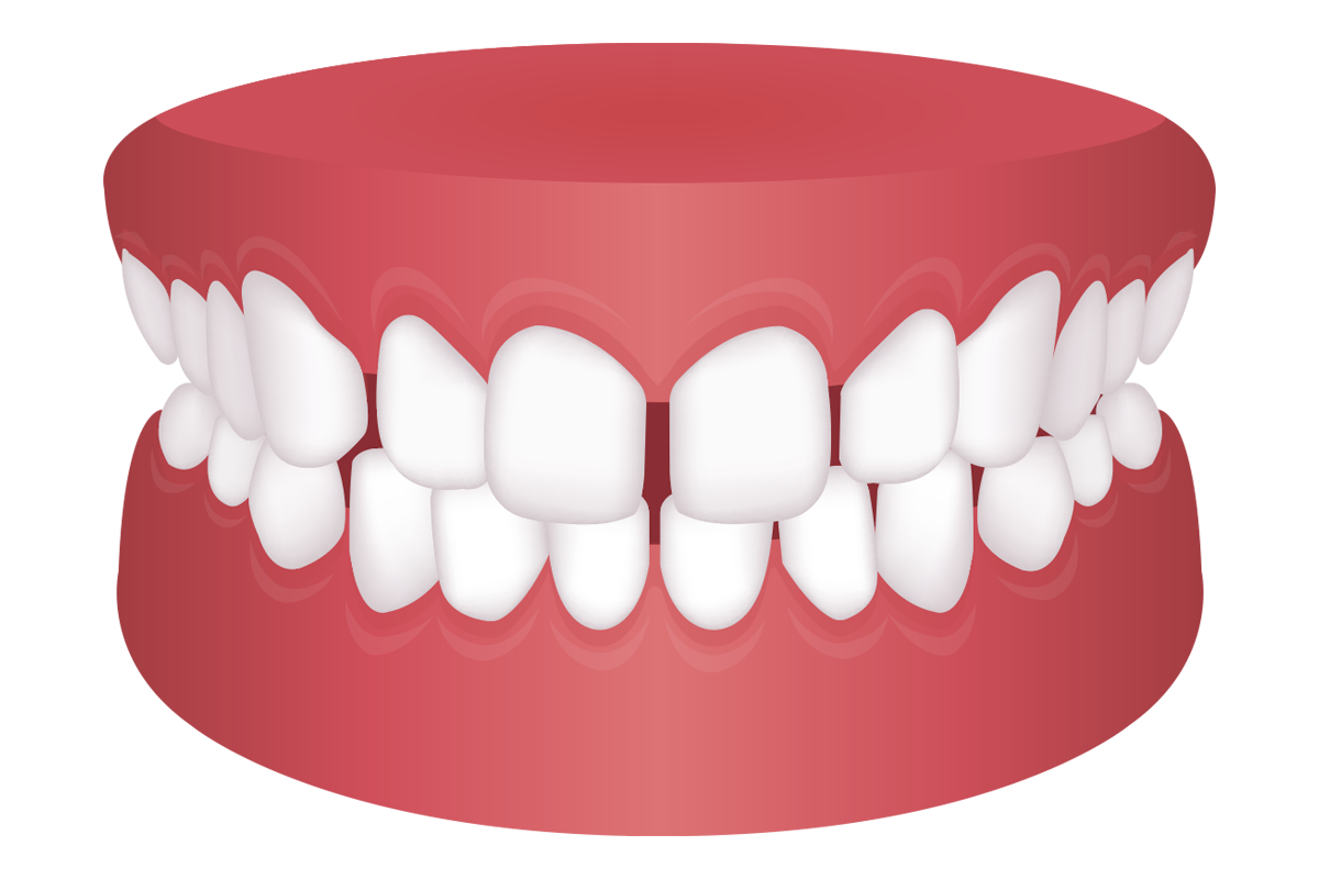 軽度な空隙歯列（すきっ歯）