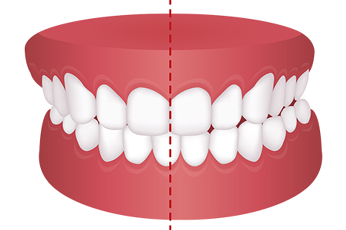 軽度な交叉咬合