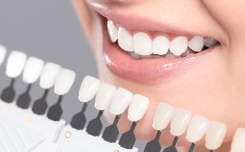 ホワイトニング