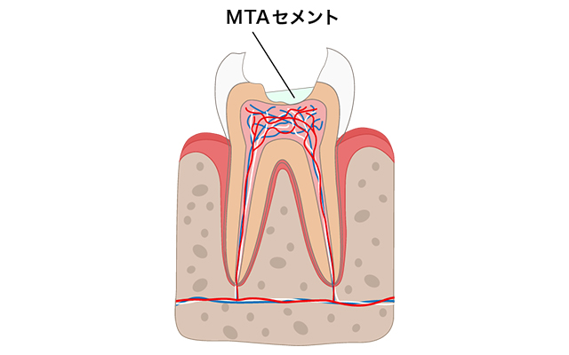 歯の神経を守るMTAセメント